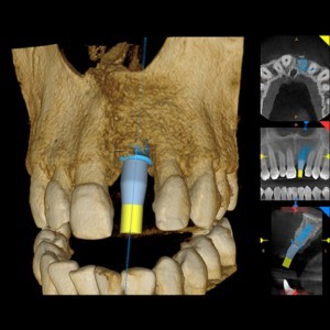 3d image of guided implant placement